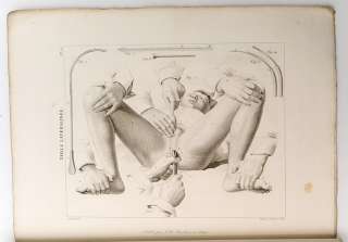 1832 France SURGERY MEDICINE w. Engravings Atlas RARE  